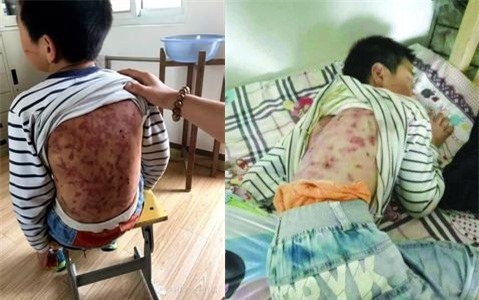 Pháp luật - Bé trai bị cha dượng đánh đập tàn nhẫn khiến dư luận phẫn nộ