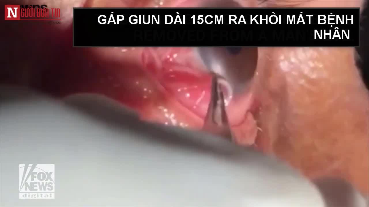 Cận cảnh gắp giun ký sinh dài 15cm ra khỏi mắt người