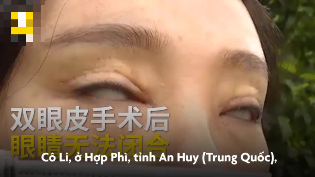 Cô gái không thể nhắm mắt sau khi phẫu thuật cắt mí