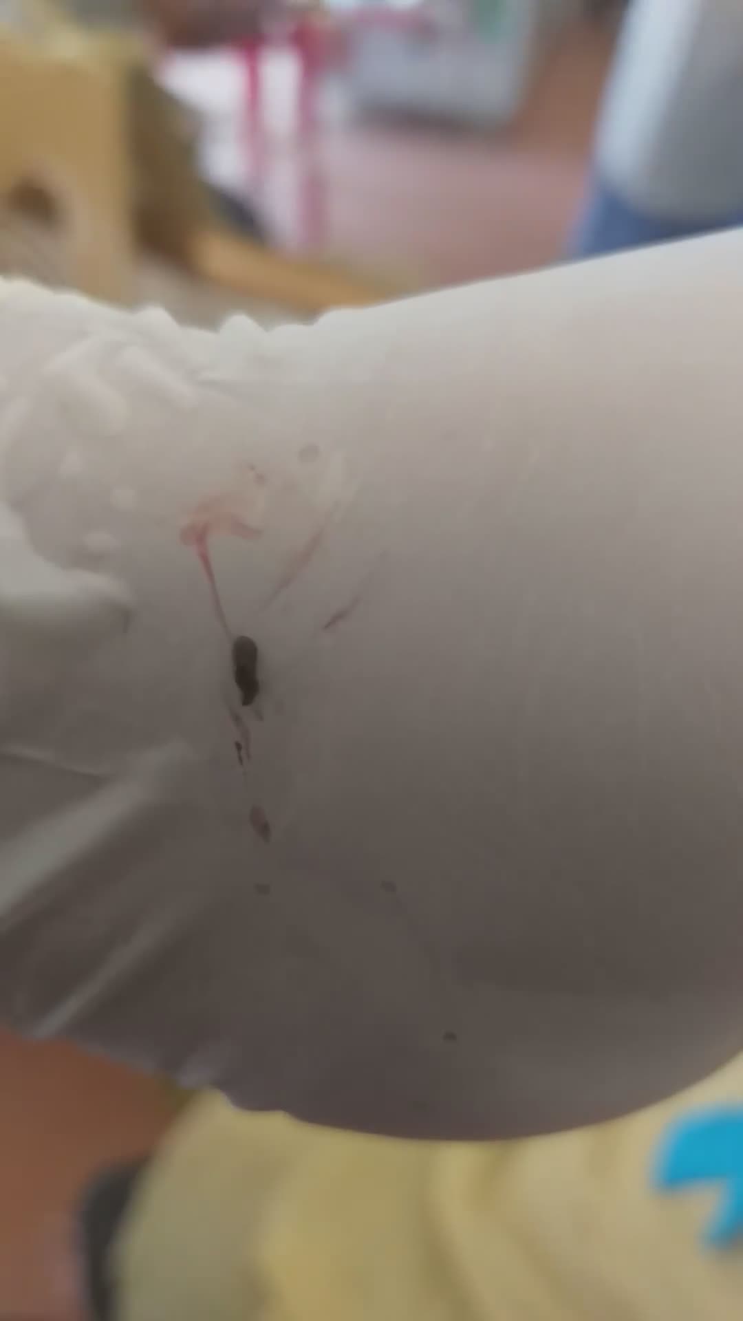 Khám mắt cho bé gái người Mông, bác sĩ phát hiện một con vắt