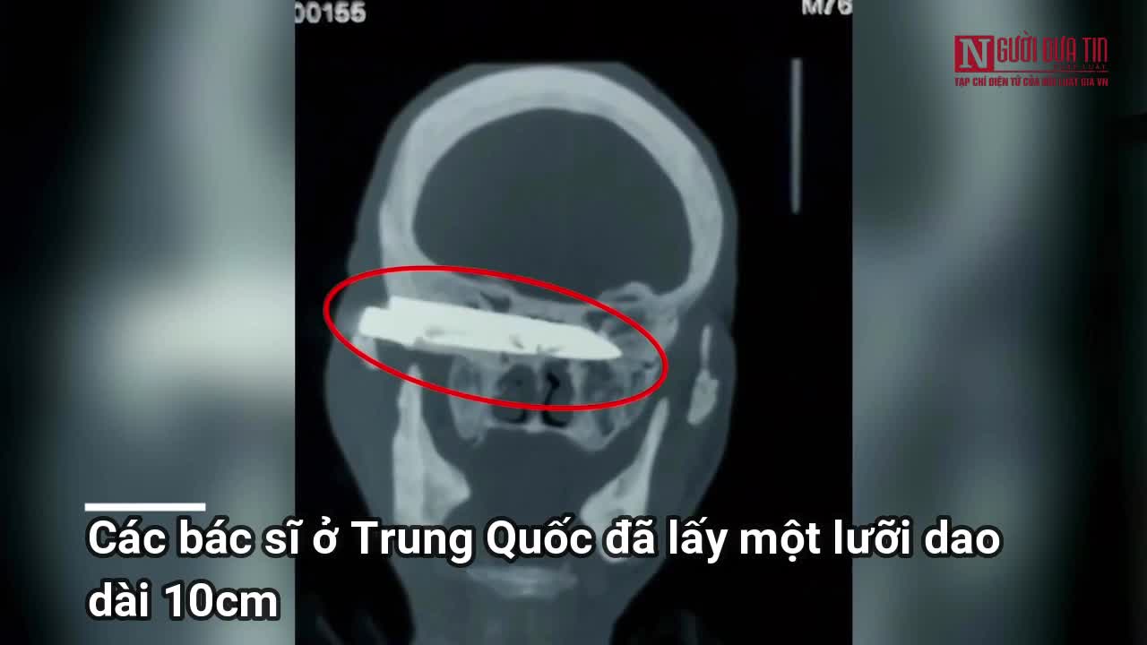 Các bác sĩ gỡ lưỡi dao mắc kẹt 26 năm ra khỏi đầu người đàn ông