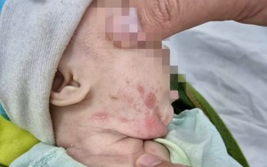 Xoắn khuẩn giang mai âm thầm xâm nhập não người bệnh- Ảnh 3.