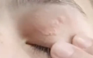 Người phụ nữ đau mắt đi khám, bác sĩ gắp ra thứ "đáng sợ" bên trong- Ảnh 3.