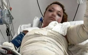 Dầu gội đầu bắt lửa, cô gái xinh đẹp bị bỏng nửa người và cái kết bất ngờ- Ảnh 5.