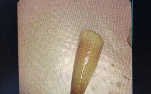 Nghe thấy &acirc;m thanh lạ trong tai, b&eacute; 7 tuổi đi kh&aacute;m th&igrave; sốc nặng - Ảnh 2.