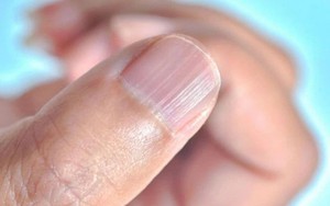 5 dấu hiệu nhận biết nốt ruồi c&oacute; nguy cơ &aacute;c t&iacute;nh, ung thư, nhất c&aacute;i số 1 kh&ocirc;ng phải ai cũng biết - Ảnh 2.