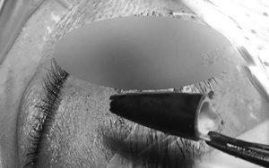 Người đ&agrave;n &ocirc;ng bị thủng ruột v&igrave; một sai lầm g&acirc;y nguy hiểm t&iacute;nh mạng - Ảnh 3.