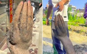 Người đ&agrave;n &ocirc;ng đau bụng 36 tiếng, b&aacute;c sĩ ph&aacute;t hiện "b&iacute; mật" b&ecirc;n trong - Ảnh 2.