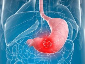 Tưởng rối loạn tiêu hóa người phụ nữ không ngờ mắc ung thư đại tràng - Ảnh 5.