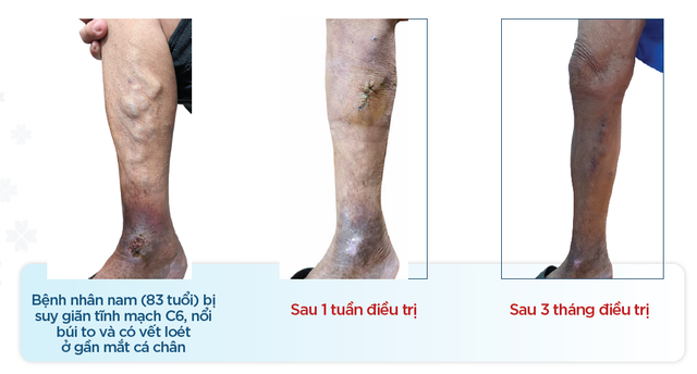 Loét chân vì 38 năm bị suy giãn tĩnh mạch không trị - Ảnh 1.