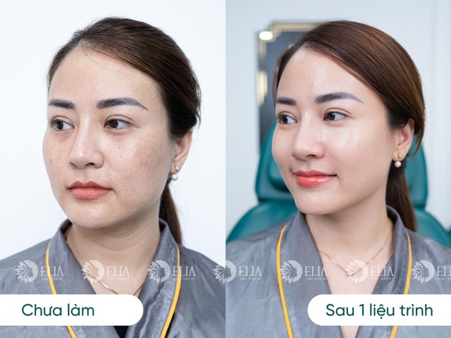 Giải mã cơn sốt cấy Meso Bio Young không nốt sần tại Viện thẩm mỹ quốc tế Elia- Ảnh 5.