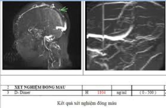 Nhiều người Việt thường mắc phải thói quen này dẫn đến đột quỵ não- Ảnh 1.