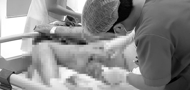Cụ ông 76 tuổi sốc nhiễm khuẩn, hoại tử vùng đùi vì sai lầm phổ biến - Ảnh 1.