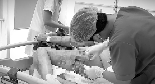 Nguy kịch sau khi tự trích mụn nhọt tại nhà - Ảnh 1.