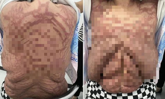 Người phụ nữ 40 tuổi, da biến dạng kinh hoàng vì sai lầm nhiều người mắc- Ảnh 2. Người phụ nữ 40 tuổi, da biến dạng kinh hoàng vì sai lầm nhiều người mắc- Ảnh 2.
