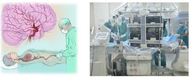 Quyết định cân não cứu sống cụ ông 95 tuổi đột quỵ nặng   - Ảnh 1.