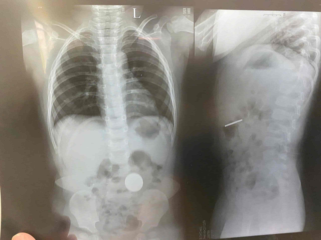 Bé trai 2 tuổi ho to liên tục, bác sĩ gắp ra thứ "đáng sợ" bên trong - Ảnh 2.