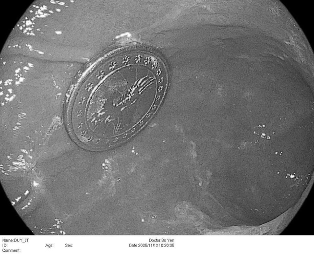 Bé trai 2 tuổi ho to liên tục, bác sĩ gắp ra thứ "đáng sợ" bên trong - Ảnh 1.