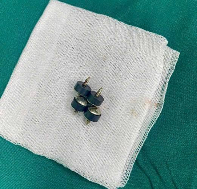 Bé trai 2 tuổi được gia đình đưa đi viện, bác sĩ gắp ra thứ "đáng sợ" bên trong - Ảnh 2.