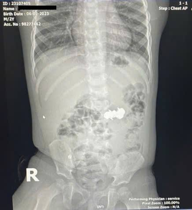 Bé trai 2 tuổi được gia đình đưa đi viện, bác sĩ gắp ra thứ "đáng sợ" bên trong - Ảnh 1.