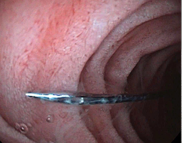 Bé trai 11 tuổi khóc kêu đau, bác sĩ gắp ra thứ "đáng sợ" bên trong- Ảnh 1.