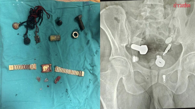 Người đàn ông liên tục đau bụng, bác sĩ sốc nặng khi phát hiện "bí mật" đáng sợ- Ảnh 2. Người đàn ông liên tục đau bụng, bác sĩ sốc nặng khi phát hiện "bí mật" đáng sợ- Ảnh 2.