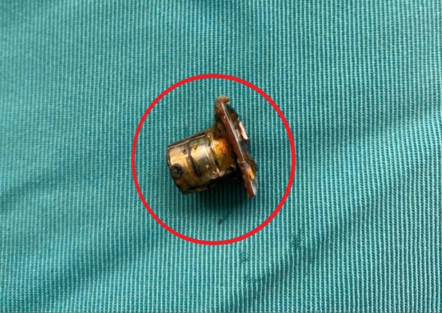 Bé 2 tuổi đau bụng thốc ngược lên, bác sĩ gắp ra thứ "đáng sợ" trong bụng - Ảnh 1.