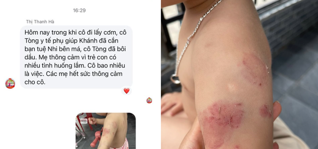 Nh&agrave; trường b&aacute;o c&aacute;o g&igrave; về vụ b&eacute; g&aacute;i 2 tuổi bị nhiều vết cắn khi học ở lớp?- Ảnh 2.