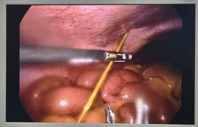 Đau bụng dữ dội, b&aacute;c sĩ ph&aacute;t hiện thứ "đ&aacute;ng sợ" 4cm nằm b&ecirc;n trong bụng - Ảnh 1.