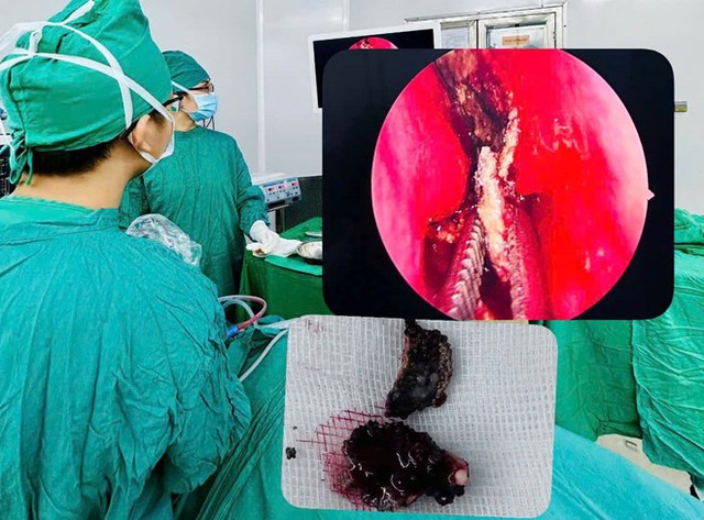 Chảy nước mũi h&ocirc;i nhiều năm, bệnh nh&acirc;n 23 tuổi đi kh&aacute;m b&aacute;c sĩ gắp ra thứ "đ&aacute;ng sợ"- Ảnh 1.