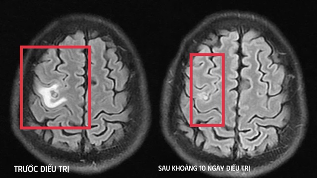 Cơn co giật bất thường h&eacute; lộ &ldquo;vị kh&aacute;ch lạ&rdquo; k&yacute; sinh trong n&atilde;o- Ảnh 1.