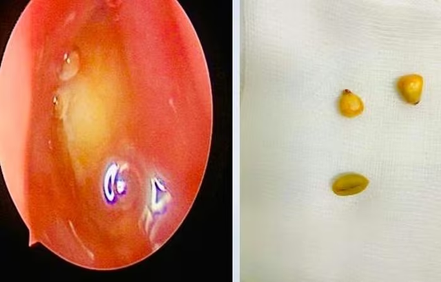 B&eacute; trai hơn 2 tuổi chảy mũi, đến viện b&aacute;c sĩ gắp ra thứ "đ&aacute;ng sợ" b&ecirc;n trong - Ảnh 1.