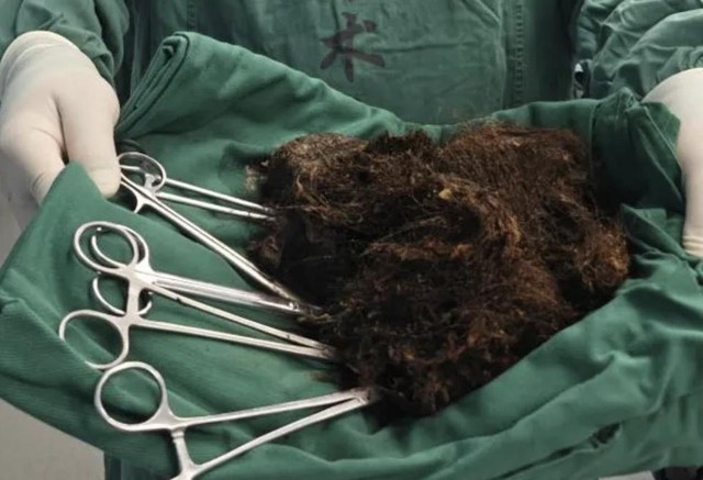 Người phụ nữ bụng "cứng như đ&aacute;", b&aacute;c sĩ ph&aacute;t hiện ra b&iacute; mật đ&aacute;ng sợ- Ảnh 1.