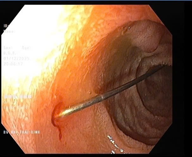 Bé trai 11 tháng khó chịu trong người, bác sĩ gắp ra thứ "đáng sợ" - Ảnh 1.