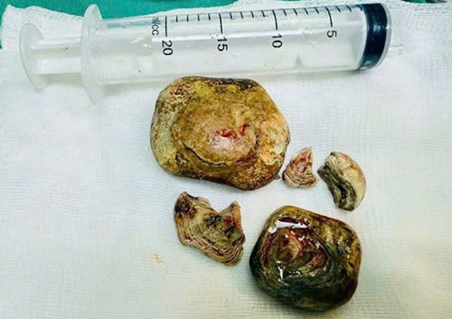 Người đ&agrave;n &ocirc;ng 43 tuổi "bụng cứng như đ&aacute;", b&aacute;c sĩ ph&aacute;t hiện b&iacute; mật "đ&aacute;ng sợ" - Ảnh 1.