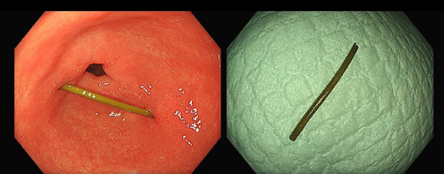 Người phụ nữ đau bụng thốc lên ngực, bác sĩ gắp ra thứ "đáng sợ" - Ảnh 1.