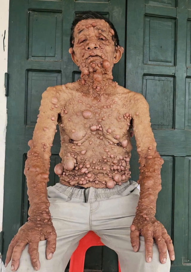 Nổi u cục khắp người bị cắt chế độ khuyết tật: Được nhận lại trợ cấp sau phản ánh của Người Đưa Tin- Ảnh 1.