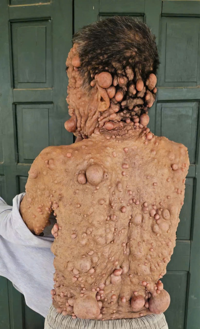 Nổi u cục khắp người bị cắt chế độ khuyết tật: Được nhận lại trợ cấp sau phản ánh của Người Đưa Tin- Ảnh 2.