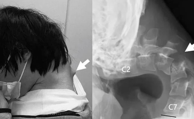 Nam thanh niên 25 tuổi không thể ngẩng đầu vì thói quen nhiều người trẻ mắc phải- Ảnh 1. Nam thanh niên 25 tuổi không thể ngẩng đầu vì thói quen nhiều người trẻ mắc phải- Ảnh 1.