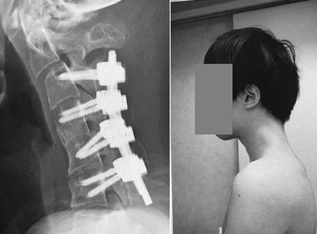 Nam thanh niên 25 tuổi không thể ngẩng đầu vì thói quen nhiều người trẻ mắc phải- Ảnh 2. Nam thanh niên 25 tuổi không thể ngẩng đầu vì thói quen nhiều người trẻ mắc phải- Ảnh 2.