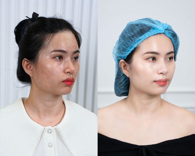 Bác sĩ Da liễu Lê Thị Ngọc Hoàn: Người đứng sau hàng ngàn case “giải cứu” sẹo rỗ thành công- Ảnh 4. Bác sĩ Da liễu Lê Thị Ngọc Hoàn: Người đứng sau hàng ngàn case “giải cứu” sẹo rỗ thành công- Ảnh 4.