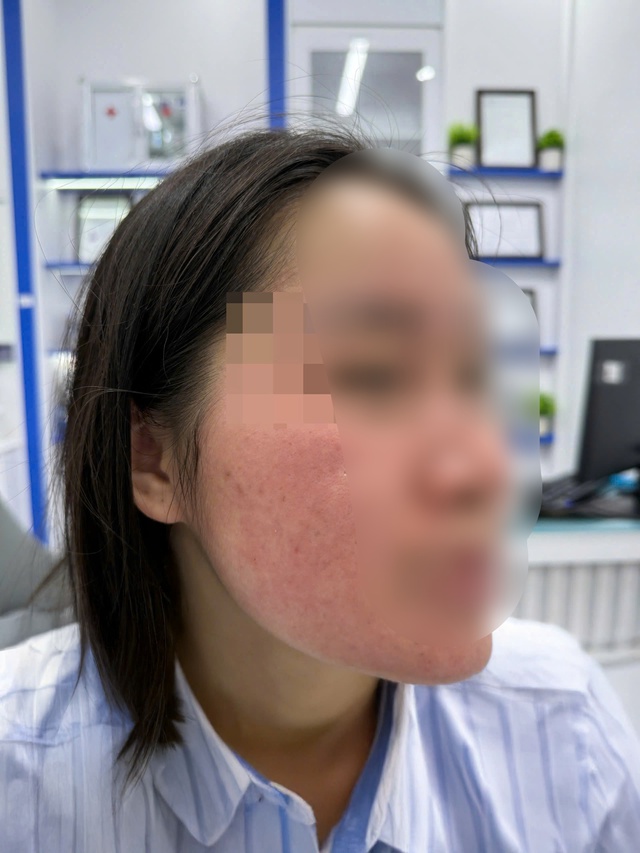 Dùng nước chanh tươi trị mụn, cô gái mặt sưng đỏ, bỏng rát- Ảnh 1. Dùng nước chanh tươi trị mụn, cô gái mặt sưng đỏ, bỏng rát- Ảnh 1.