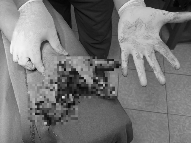 Người đàn ông 42 bị dập nát bàn tay vì thói quen khó bỏ- Ảnh 1. Người đàn ông 42 bị dập nát bàn tay vì thói quen khó bỏ- Ảnh 1.