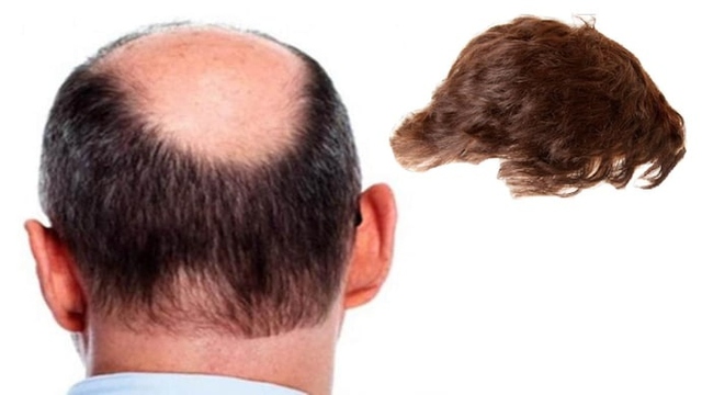 Cô dâu ngất xỉu khi phát hiện chú rể bị hói đầu trong đám cưới- Ảnh 1. Cô dâu ngất xỉu khi phát hiện chú rể bị hói đầu trong đám cưới- Ảnh 1.