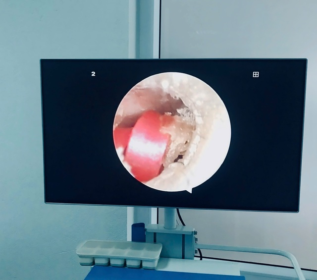 Bé gái 6 tuổi suýt thủng màng nhĩ vì sợi dây buộc tóc- Ảnh 1. Bé gái 6 tuổi suýt thủng màng nhĩ vì sợi dây buộc tóc- Ảnh 1.