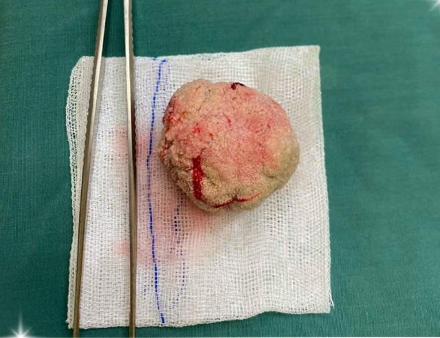 Cụ ông 98 tuổi có sỏi bàng quang "khủng" như quả trứng gà- Ảnh 1. Cụ ông 98 tuổi có sỏi bàng quang "khủng" như quả trứng gà- Ảnh 1.