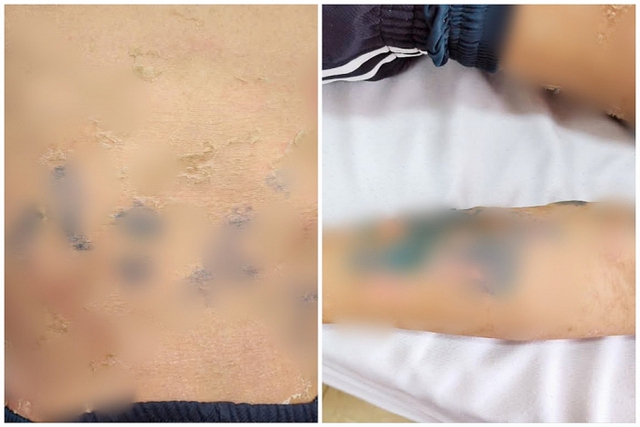 Tự đắp lá chữa bệnh sởi, nam thanh niên 17 tuổi nhập viện gấp- Ảnh 1. Tự đắp lá chữa bệnh sởi, nam thanh niên 17 tuổi nhập viện gấp- Ảnh 1.