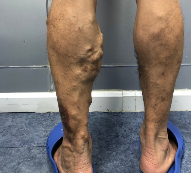 Căn bệnh diễn tiến âm thầm có dấu hiệu trẻ hóa, dân văn phòng có nguy cơ mắc - Ảnh 2.