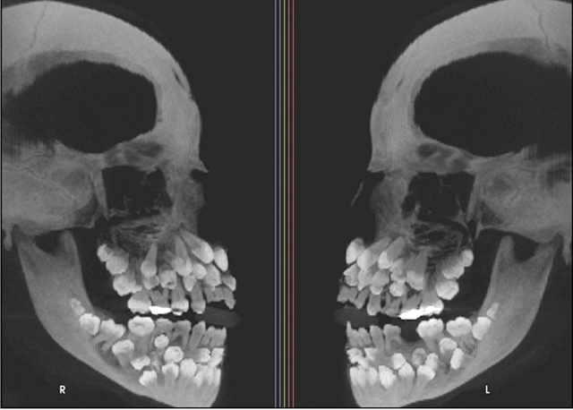 Đi nhổ răng sữa, bé gái khiến nha sĩ sốc nặng khi có 81 chiếc răng- Ảnh 1. Đi nhổ răng sữa, bé gái khiến nha sĩ sốc nặng khi có 81 chiếc răng- Ảnh 1.