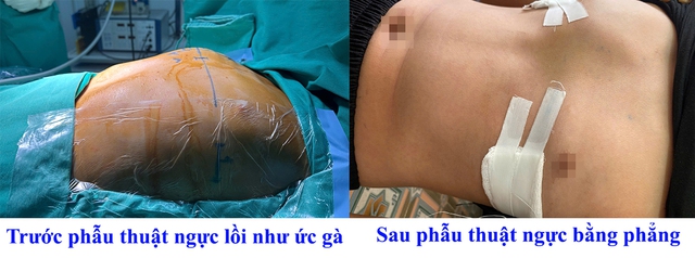 Bé trai 12 tuổi tự ti vì lồng ngực nhô cao như "ức gà" - Ảnh 1.